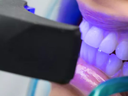 Teeth Whitening in Hilliard, OH - Postle Dental Group
